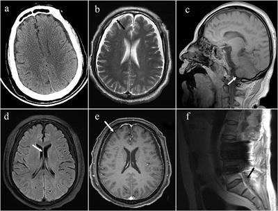 Seizures and Consciousness Disorder Secondary to Intracranial Hypotension After Spinal Surgery: A Case Report and Literature Review